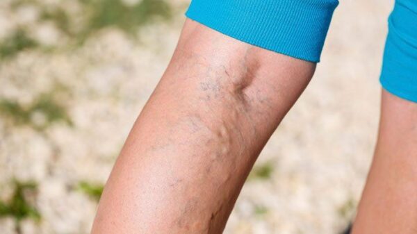 6 Things You Need To Know About Varicose Veins